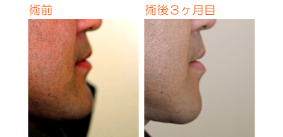 顎削り(オトガイ骨切り) 術後3ヶ月目_c0193771_1135134.jpg