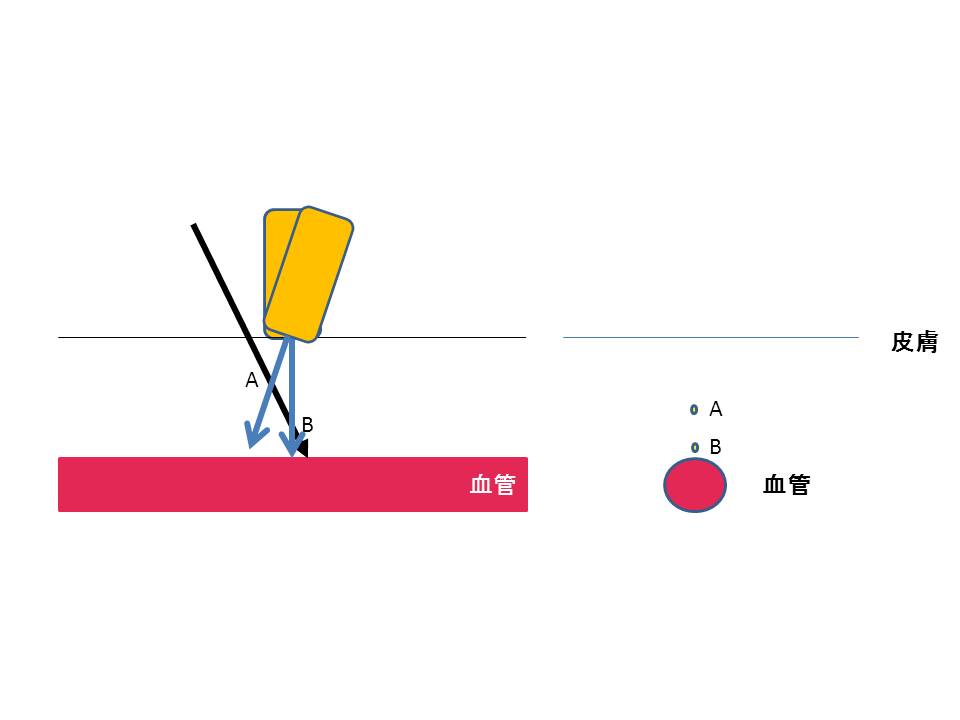 超音波ガイド下CV穿刺を考える③_a0048974_22471455.jpg