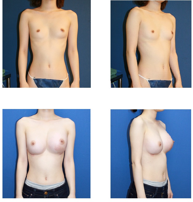 脂肪移植豊胸術　　一年に三回施術後半年後再診_d0092965_23271023.jpg