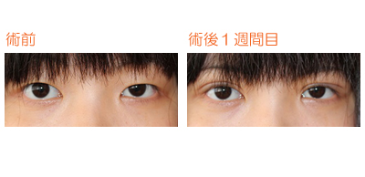 二重(埋没法) 術後1週間目_c0193771_14503869.jpg