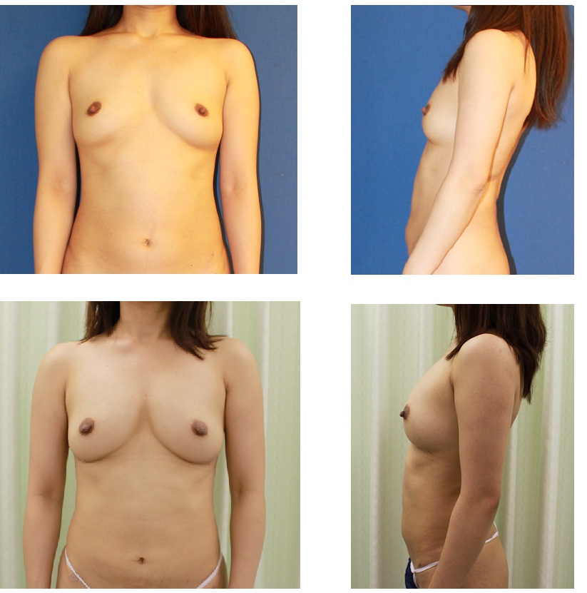 脂肪移植豊胸　　2回目術後約１．５か月_d0092965_1271629.jpg