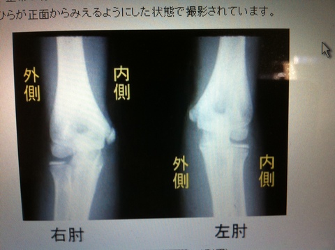 野球肘 Gold Mallon 野球肘 Gold Mallon
