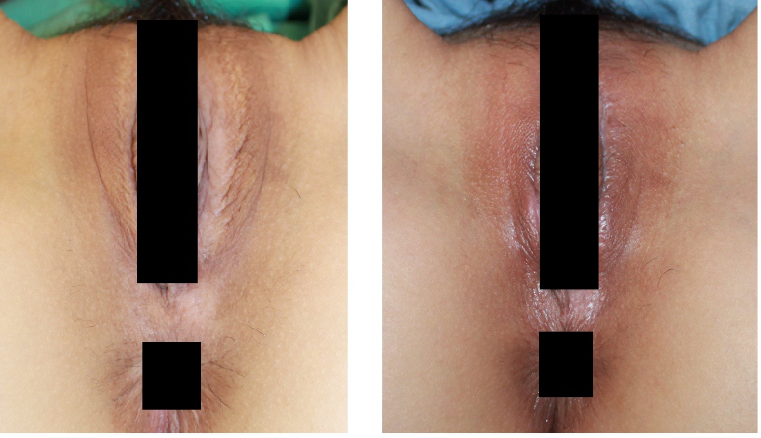 症例 小陰唇縮小 小陰唇縮小術で痛みや見た目のコンプレックス解消｜特徴と効果説明・女性医師の指名可能｜【公式】オザキクリニック