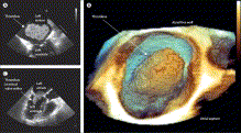 直径6cmの左房内浮遊血栓:LancetのClinical Picture_a0119856_2229208.gif