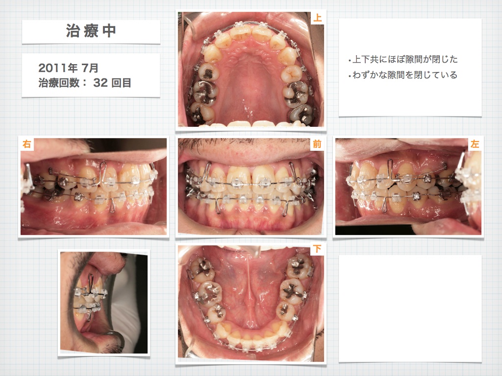 治療例:T・Hさん 成人男性の高度な叢生と上顎前突の治療例_e0025661_17382722.jpg