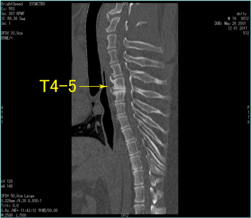 馬尾症候群　「MRI/CT」_f0025769_12563327.jpg