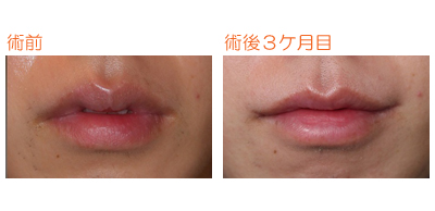 口角つり上げ 術後３ヶ月目 ｄｒ勝間田のブログ