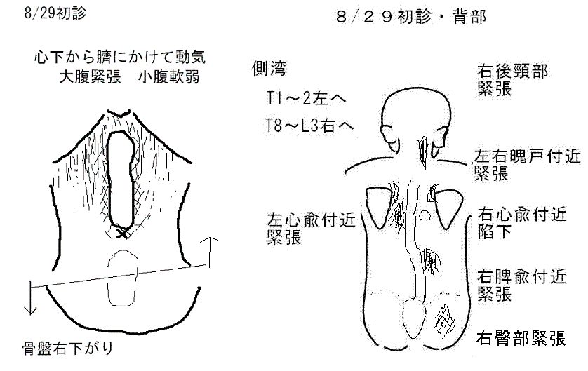  多種の刺激に反応する蕁麻疹-2四診_a0223458_8141776.gif