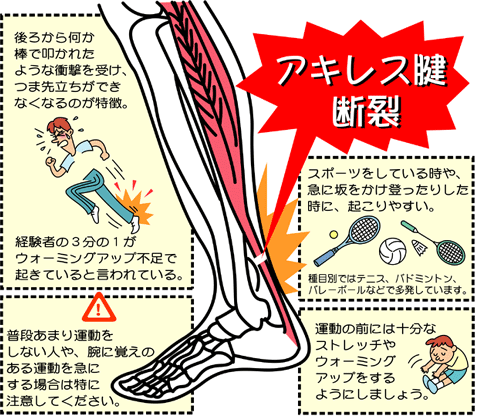 アキレス腱断裂なう 1 杉並区松ノ木ウエルシア薬局近く キミはボクを見たかい 4 アキレス腱断裂なう 1 杉並区松ノ木ウエルシア薬局近く キミはボクを見たかい 4