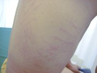 しいたけ皮膚炎_a0221584_10361913.jpg
