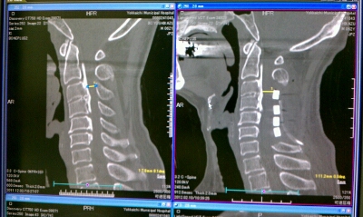 頸椎後縦靭帯骨化症 生きるためにcafenet