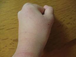 懲りました。・・?(手の腫れ)_e0097212_0552960.jpg