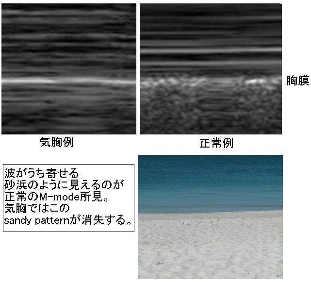 気胸の診断における超音波のメタアナリシス_e0156318_7254661.jpg