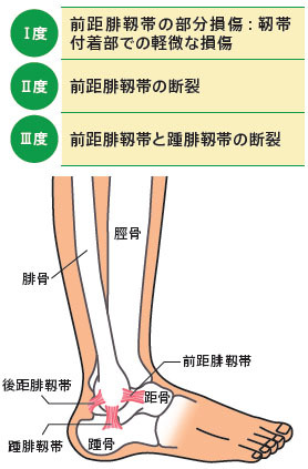 【捻挫】2時間おきに氷で冷やし免荷_c0219358_0415787.jpg