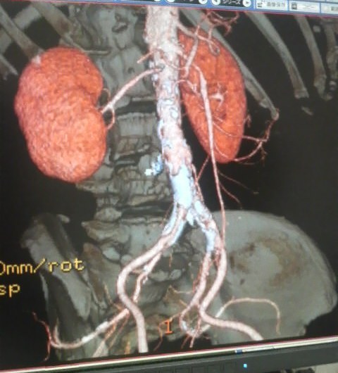 大動脈瘤事件無事解。肝臓がんは無し。問題は動脈硬化（左手、骨盤高さの足への分技周辺））_e0082956_6172236.jpg