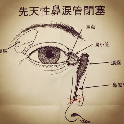 先天性鼻涙管閉塞 何となく何となく 先天性鼻涙管閉塞 何となく何となく