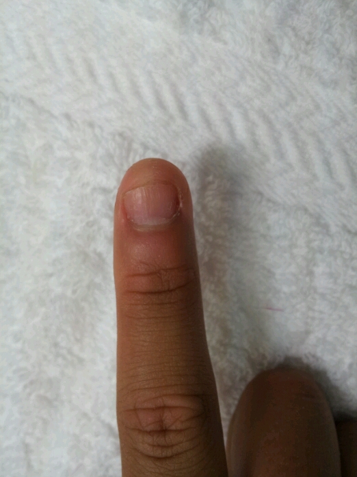 深爪さんbefore After 熊本市 南区 江越 ネイルサロン Karina Nail
