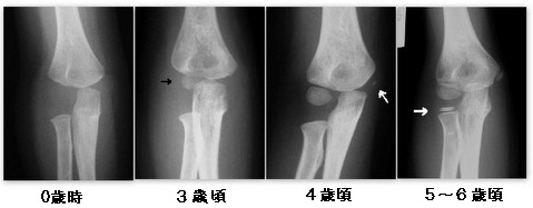 幼児期の骨折 竹ちゃん道楽 幼児期の骨折 竹ちゃん道楽