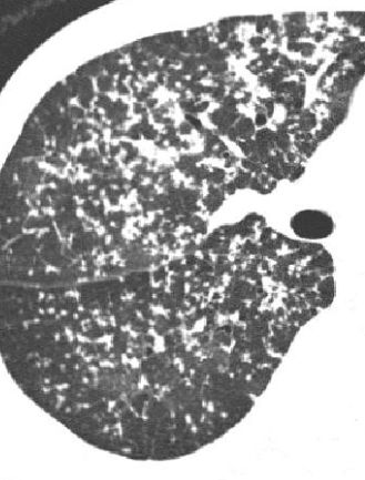 粟粒