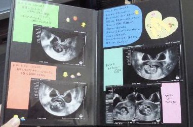 妊娠 17週6日 5カ月 ユメミルカメラ 妊娠 17週6日 5カ月 ユメミルカメラ