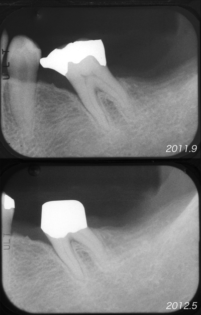 2011.12  傾斜歯の続き_f0103459_15394823.jpg