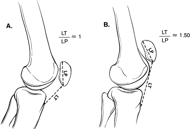 Camelback SignとPatella alta。_b0112009_1515283.png