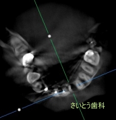 抜歯が無難だと思いますが_b0196070_21475114.jpg