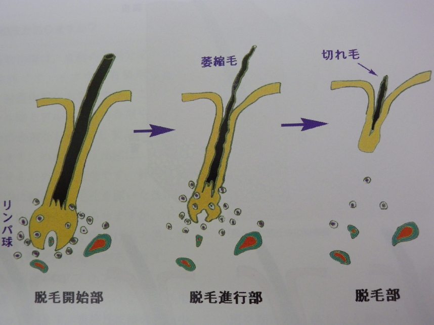脱毛症の種類と治療 円形脱毛症 札幌の美容皮膚科小笠原クリニック澄川診療所 シミ シワ ニキビ アトピー治療