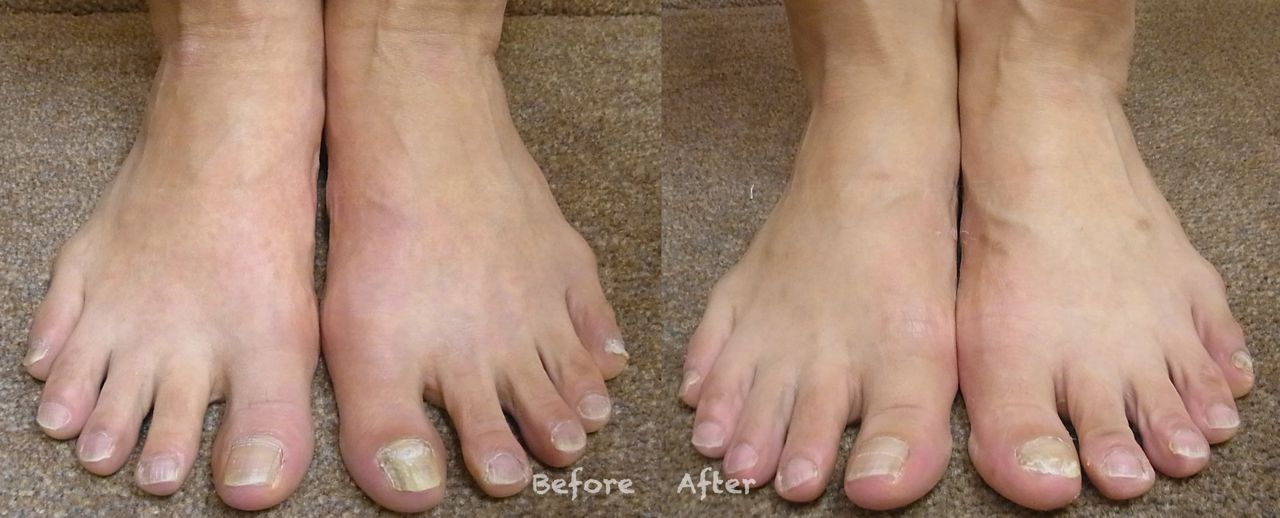 外反母趾で開帳足 林足研究所 足 外反母趾 修正 日常の日記