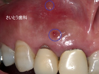 歯根破折の診断_b0196070_20335296.jpg