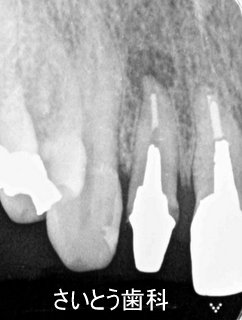 歯根破折の診断_b0196070_203519100.jpg