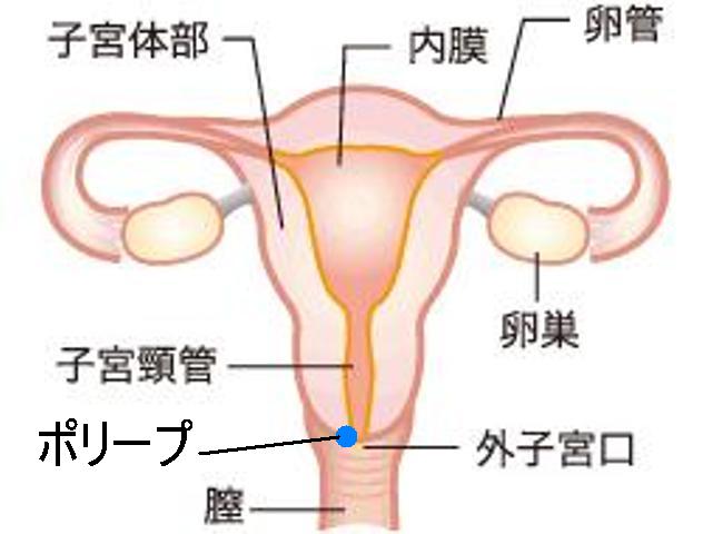 子宮 頚 管 ポリープ