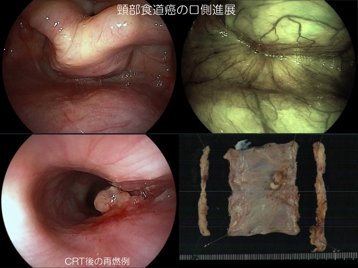 頸部食道癌の手術_b0180148_7264429.jpg