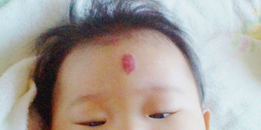 苺状血管腫 その4 ほっぺとイチゴ 苺状血管腫 その4 ほっぺとイチゴ