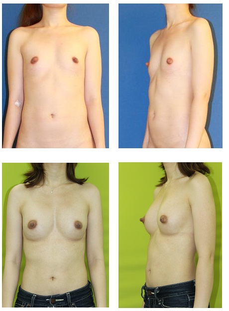 脂肪移植豊胸　一年間に3回　　最終施術より術後15カ月_d0092965_2382798.jpg