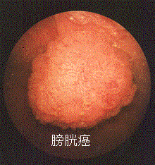 症状のない血尿は大丈夫?_a0221584_9561346.gif