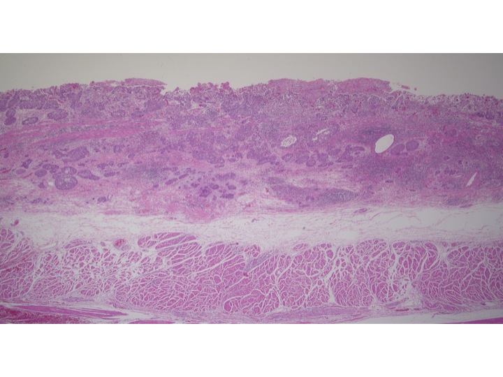 病理 : 食道癌のブログ
