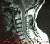 初期での安静は重要_e0097212_21425179.jpg