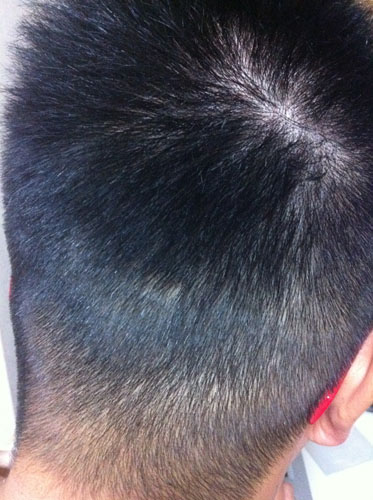 頭の傷が 相羽純一の改過自新 頭の傷が 相羽純一の改過自新