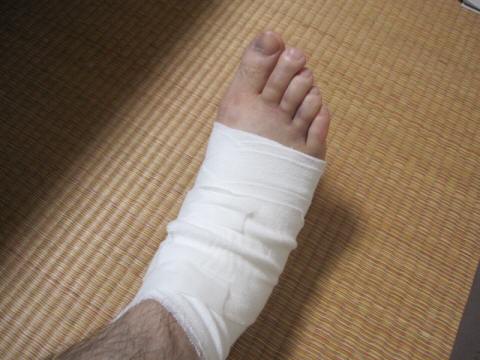 骨挫傷 徒然なるままに 骨挫傷 徒然なるままに