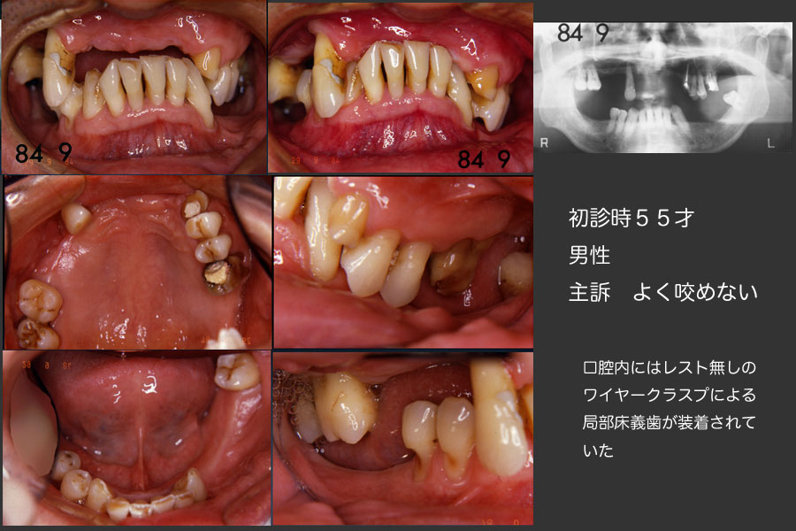 すれちがい咬合との28年その１ ふじむら歯科医院 ブログ