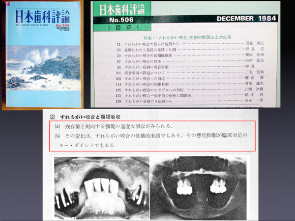 すれちがい咬合との28年その2_f0154626_13311969.jpg