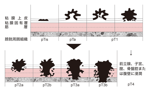 経尿道的膀胱腫瘍切除術について_a0221584_1591384.gif