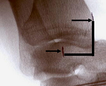 足首を捻ったら、治療すべきは本当に靱帯？―Distal Tibfib Joint Mobilizationsについて考える。_b0112009_99023.png