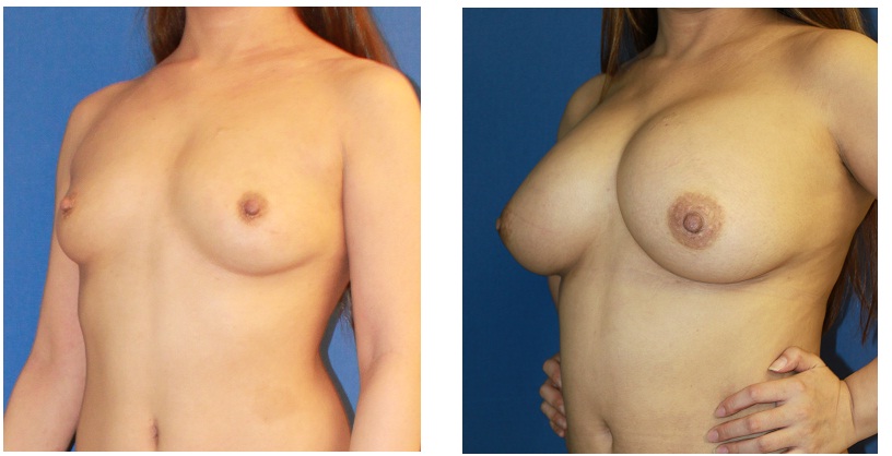 脂肪移植豊胸　３回施術後約１年３か月後再診時_d0092965_2331299.jpg