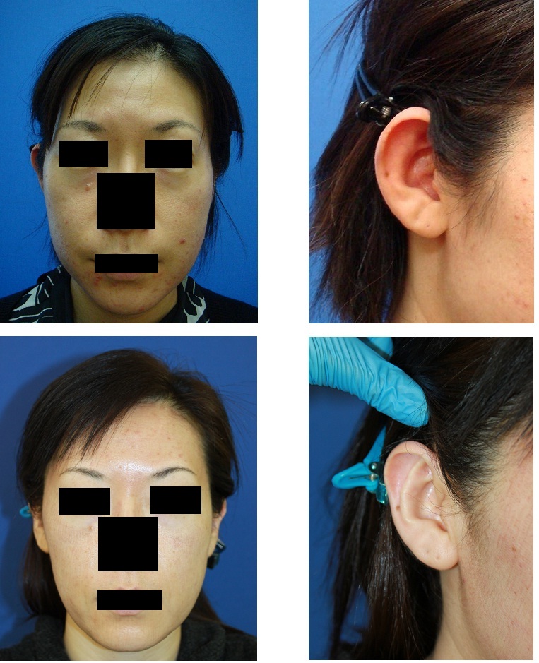 右耳立耳修正術　（クローズ法）術後　４年３か月_d0092965_2115239.jpg