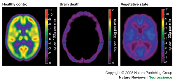 【画像+動画ｱﾘ】：脳スキャンを使い、12 年間植物状態だった男性との対話に成功!!_a0293798_393312.jpg