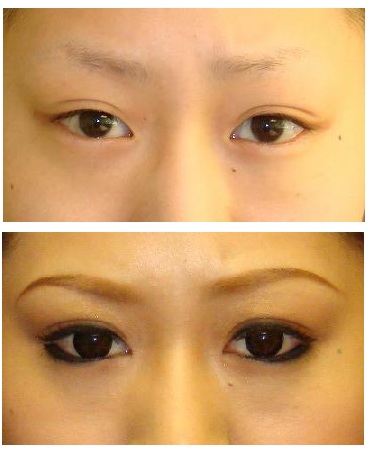 目頭切開形成術、二重切開形成　上眼瞼脂肪除去_d0092965_23583482.jpg