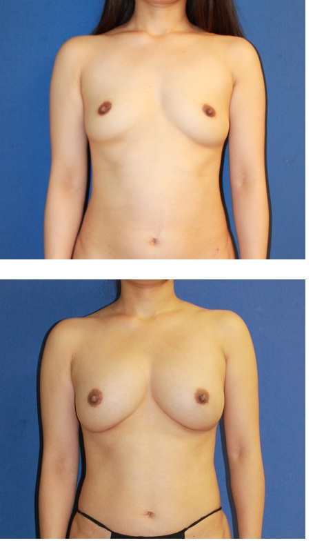 脂肪移植豊胸　一年に３回　最終手術より術後約１年_d0092965_150731.jpg