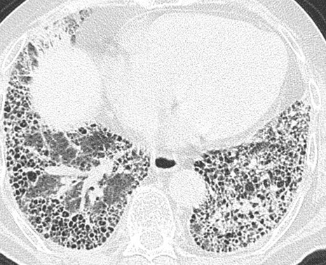 胸部CTにおける蜂巣肺の定義_e0156318_11542251.jpg